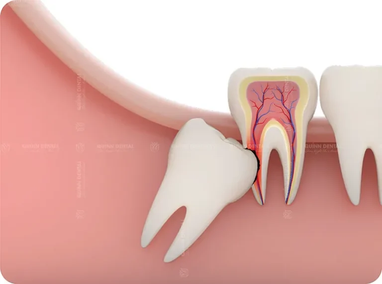 Nhổ răng không sang chấn tại Nha Khoa Quinn Dental