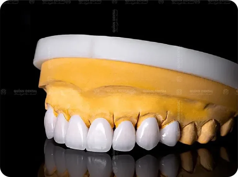 Bọc răng sứ thẩm mỹ tại Nha Khoa Quinn Dental
