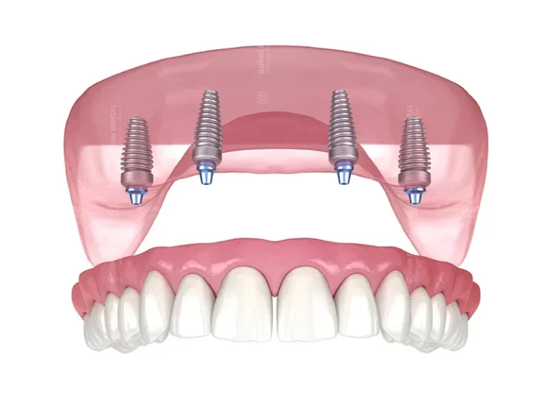 Trồng răng implant tại Nha Khoa Quinn Dental Cầu Giấy